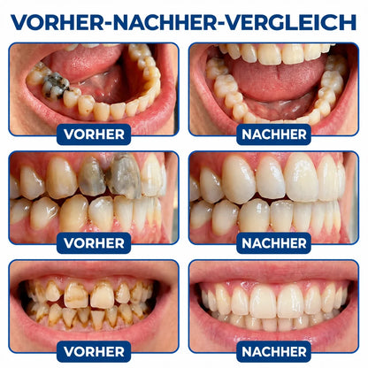 Dr.Fachmer® DentRestore Zahnreparatur- und Füllsystem 🌻