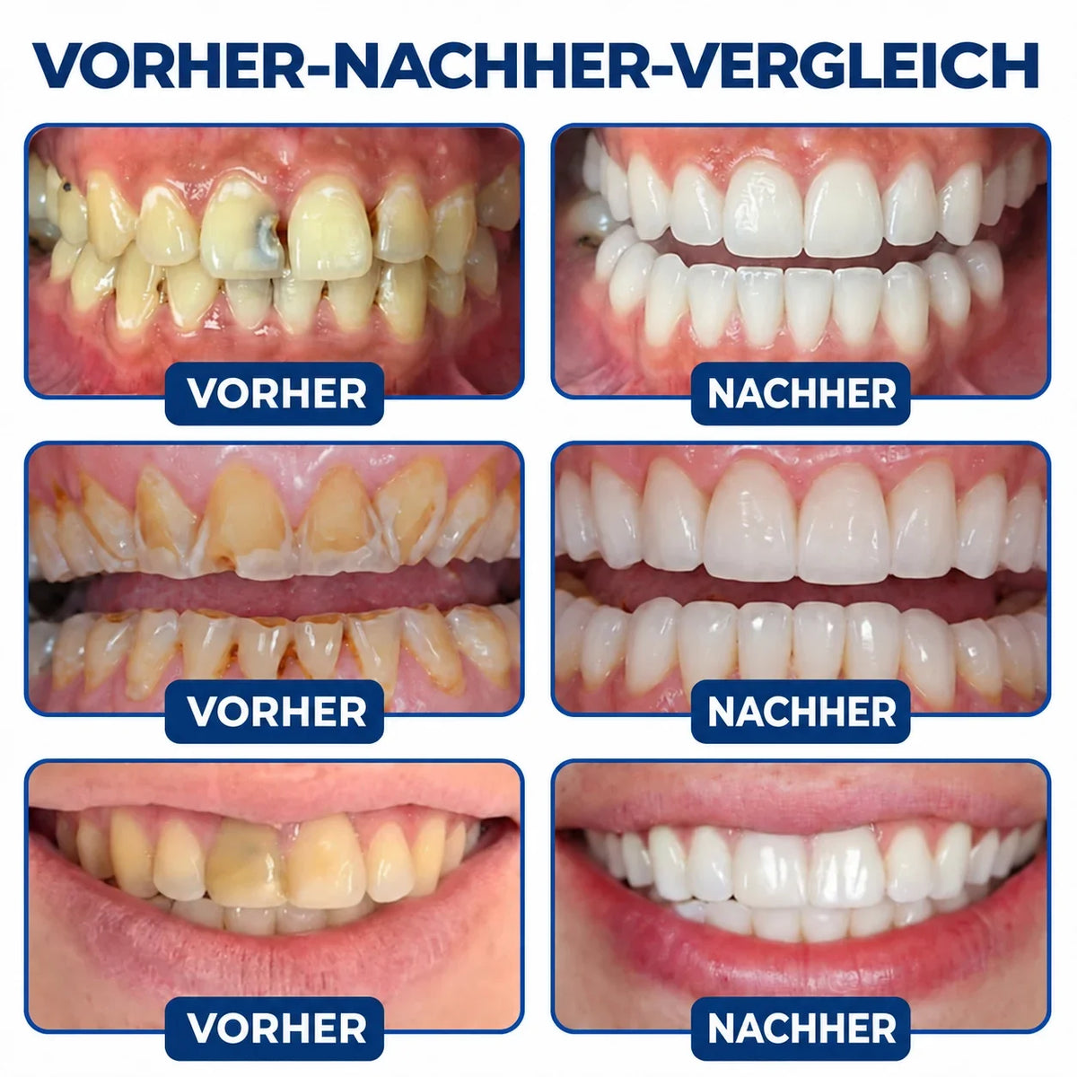 Dr.Fachmer® DentRestore Zahnreparatur- und Füllsystem 🌻